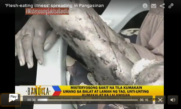 Flesh Eating illness Spreading in Pangasinan