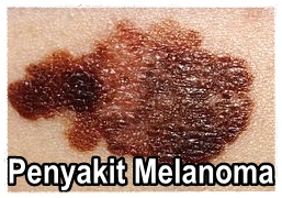 Cara Mengatasi Penyakit Melanoma Paling Efektif