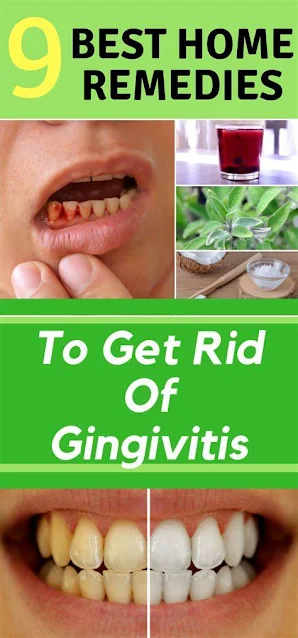 9 Best Home Remedies To Get Rid Of Gingivitis