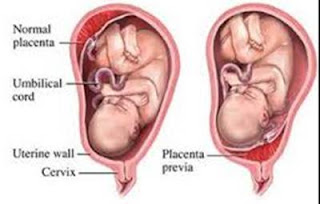 Manajemen Asuhan Kebidanan pada Ibu Hamil dengan Plasenta Previa