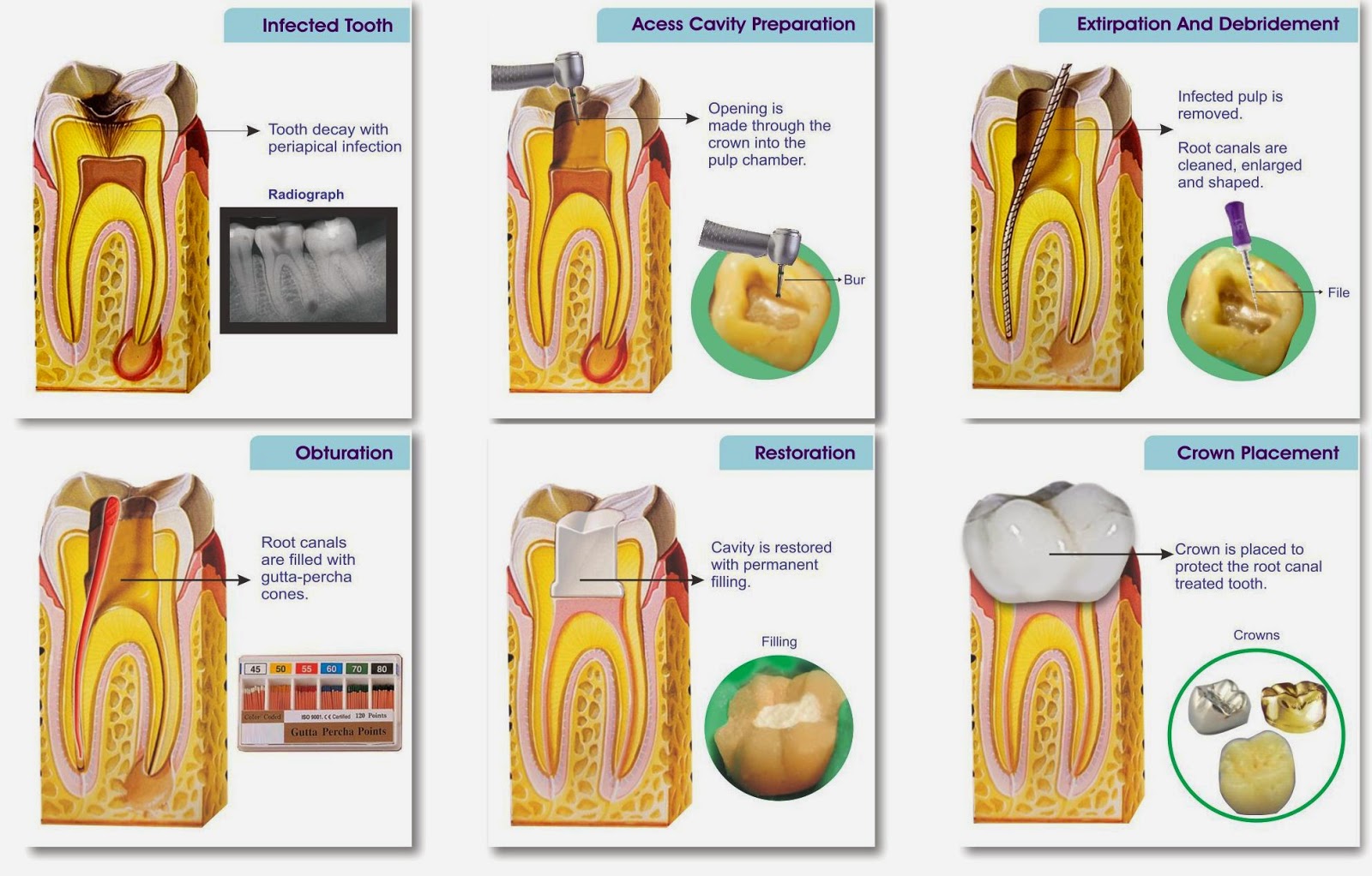 Root Canal Procedure