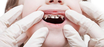 Thuốc giảm đau răng cho trẻ em tại nhà 1