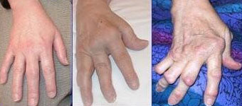 artritis-sintomas-guia-1