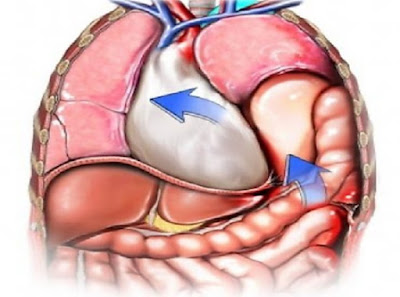 Congenital Diaphragmatic Hernia