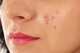 Tips to remove pimples fast: Apply honey, ripe papaya, basil leaves juice, honey and mustard juice, aloe vera gel to remove pimples fast..