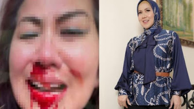 Wajah Venna Melinda Penuh Darah, Diduga Alami KDRT oleh Ferry Irawan, Saksi: Ngeri Banget