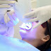 Ưu điểm khi tẩy trắng răng bằng laser whitening