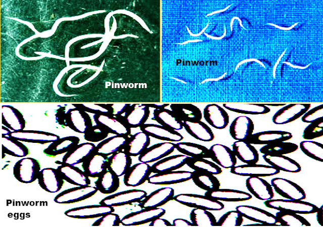 Pinworm Infections.