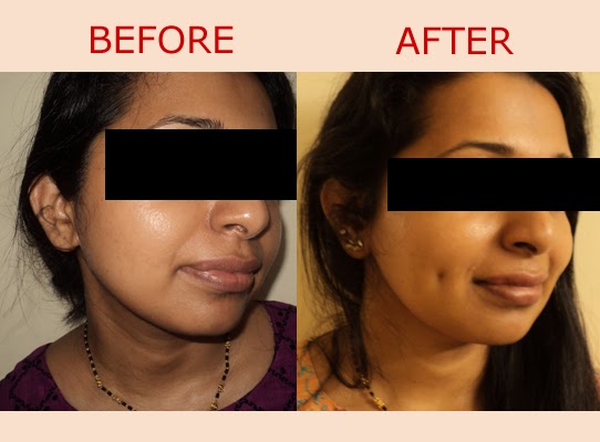 How to get dimples naturally staying at home ~ Without Surgery