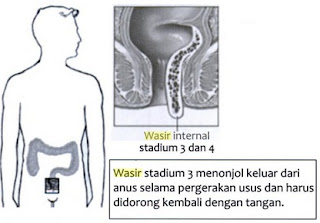  20 Obat Ambeien/Wasir Tradisional, Obati Ambeien Enggak Harus Mahal..