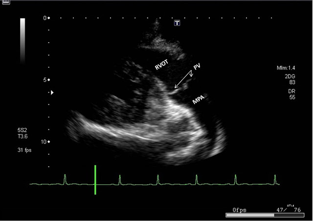 Parasternal RV Outflow view showing RVOT, Main Pulmonary artery (MPA) and Pulmonary Valve