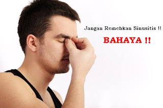 obat tradisional untuk menyembuhkan sinusitis yang ampuh