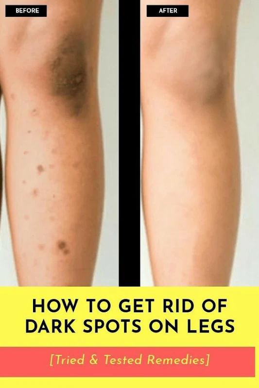 Home Remedies for Dark Spots on Legs, Knees and Thighs