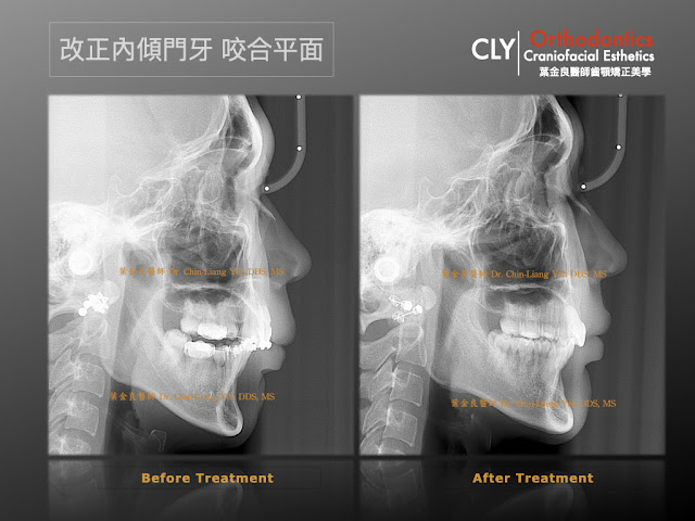 矯正後牙齒內傾？齒顎矯正專科挽救副作用