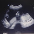 Anda Tidak Akan Percaya Apa yang Dilakukan Oleh Bayi yang Ada di Dalam Kandungan Ini