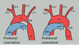 Coarctation of Aorta