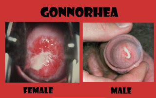 obat herbal untuk penyakit gonore