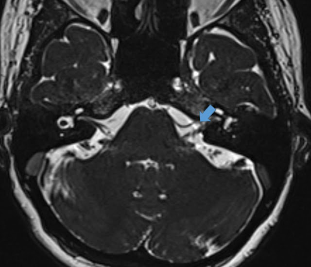 Type II AICA loop in left IAC