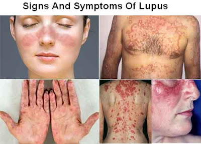  Lupus is a form of rheumatism in the connective tissue Lupus Disease Signs And Symptoms, Diagnosis And Treatment