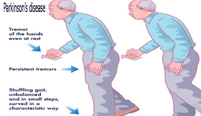 Parkinson’s disease