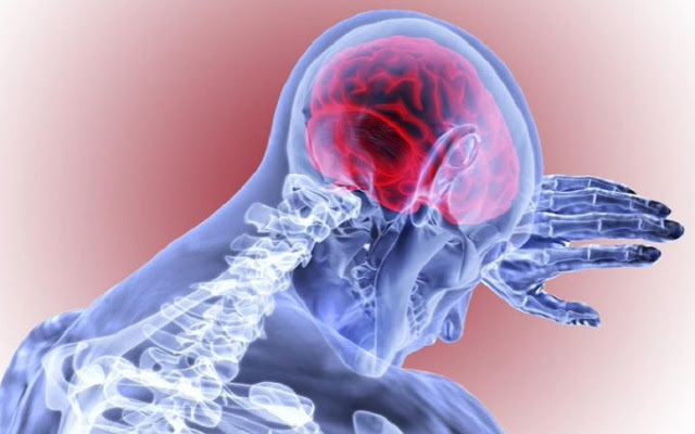 Gejala dan Penyebab Pendarahan Otak yang Dialami Indra Bekti