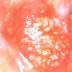 Leukoplakia