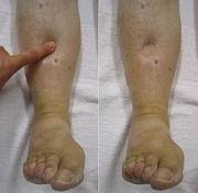  Edema é observável edema de acúmulo de líquido nos tecidos do corpo. Comumente ocorre mais Edema nos pés e pernas , onde é conhecido como edema periférico.