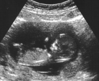 sonogram 5 weeks. The ultrasound above is from