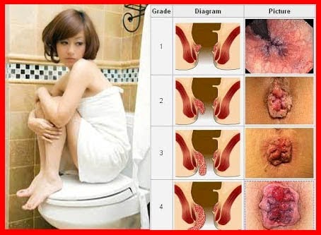 ambeien, Kesehatan, obat ambeien herbal, obat ambeien tanpa operasi, Obat Herbal, obat herbal ambeien, obat herbal wasir, Obat wasir herbal, obat wasir tanpa operasi, Wasir, 