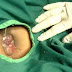 Obat Herbal Wasir Ambeien Alami thumbnail