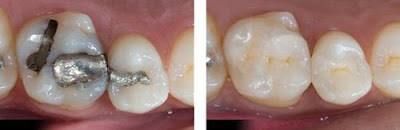 Phân tích các nguyên nhân sâu răng và cách phòng tránh-2