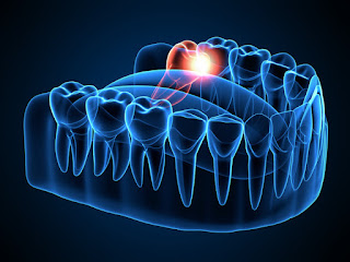 wisdom tooth aftercare extraction