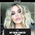 Khloe Kardashian Opens Up On Her Cancer Scare And Having 8 Inches Of Skin Removed