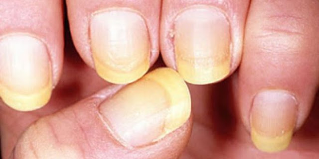  Yellow Nail Syndrome Homeopathy Treatment in Chennai 