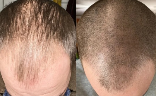 Minoxidil Results After 1 Year