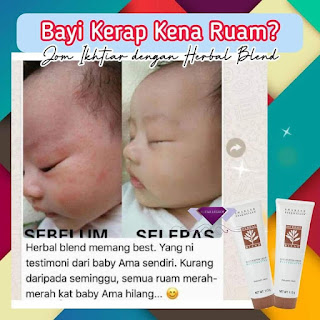 Krim Ruam Susu Peluh Lampin Gatal Bayi Di Muka Leher Pipi