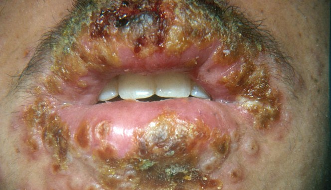 cara menyembuhkan penyakit herpes