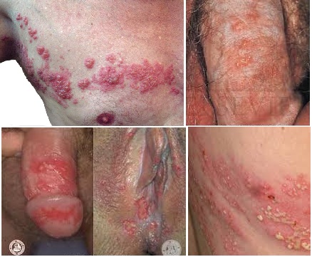 cara menyembuhkan herpes