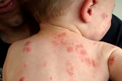 Treatment For Eczema In Children: What Is Eczema