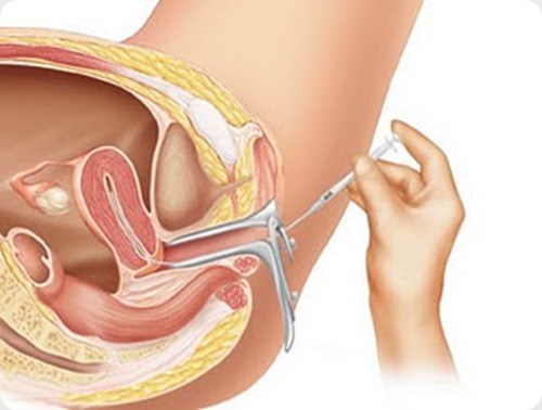 inseminacion-artificial