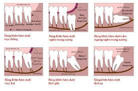  Nhổ răng khôn số 8 như thế nào?