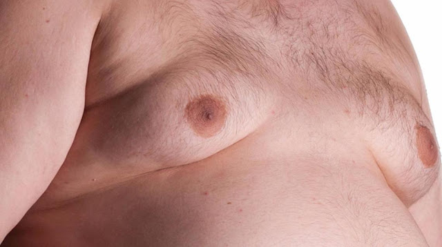 Prominent Causes of Gynecomastia