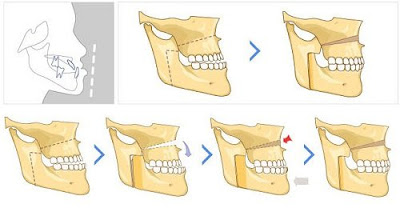 Giới thiệu quy trình phẫu thuật hàm hô móm đạt chuẩn