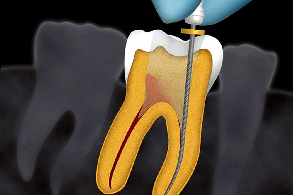 Endodontics