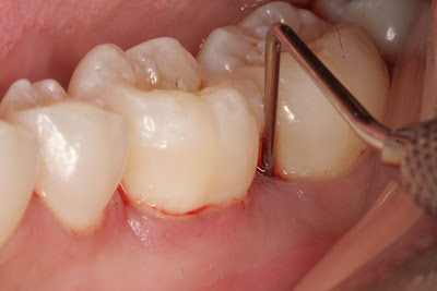 Răng sâu bị lung lay nặng có nhổ không?
