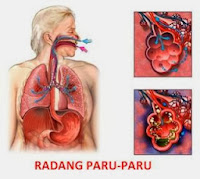 Cara Cepat Menyembuhkan Radang Paru-Paru Secara Alami