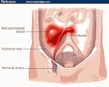 Blood Spill Into Peritoneum