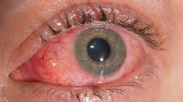 Conjunctivitis