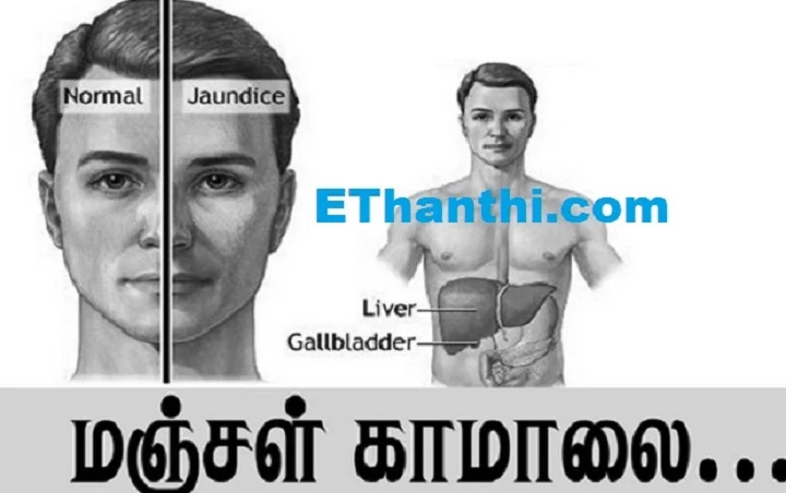 மஞ்சள் காமாலை வந்தால் என்ன செய்யலாம்? #HepatitisB