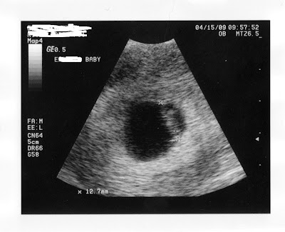 12 5 week ultrasound. sonogram 5 weeks.